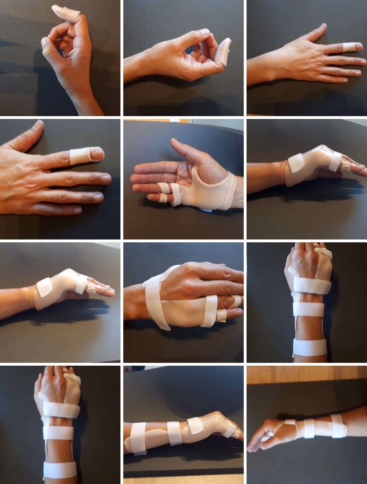 Orthèse sur mesure adaptée à la pathologie du patient